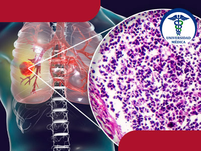 Cancer de pulmon small cell y mesotelioma